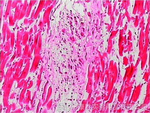 風(fēng)濕性心肌炎切片